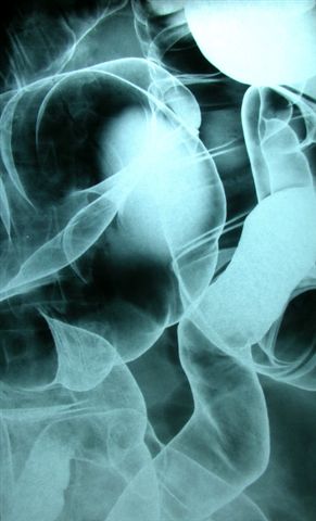 air contrast barium enema